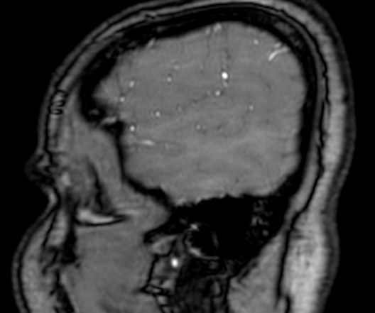 Cerebral arteriovenous malformation at posterior body of corpus callosum (Radiopaedia 74111-84925 J 20).jpg