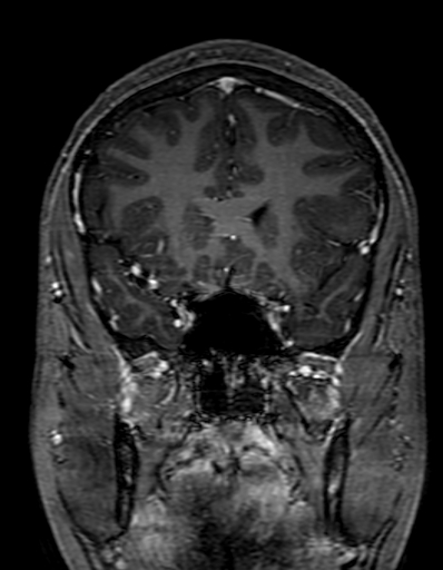 Cerebral arteriovenous malformation at posterior body of corpus callosum (Radiopaedia 74111-84925 K 116).jpg