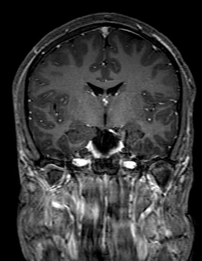 Cerebral arteriovenous malformation at posterior body of corpus callosum (Radiopaedia 74111-84925 K 172).jpg