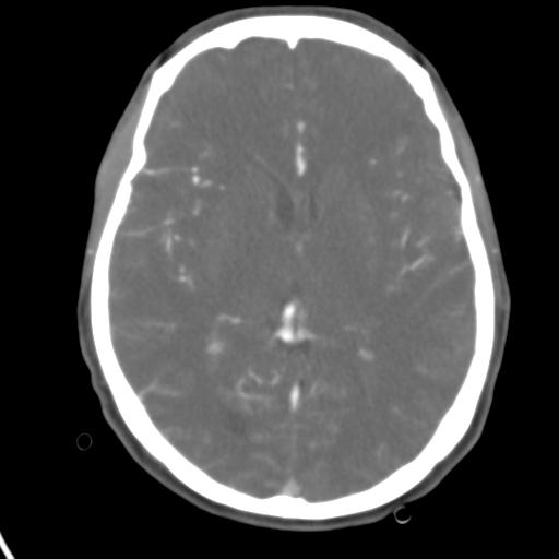 Cerebral arteriovenous malformation with hemorrhage (Radiopaedia 28773-29073 A 28).jpg