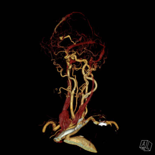 File:Cerebral arteriovenous malformation with lobar hemorrhage (Radiopaedia 44725-48512 3D VRT 6).png