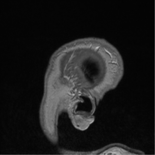 Cerebral cavernoma and development venous anomaly (Radiopaedia 37603-39482 Sagittal T1 C+ 90).png