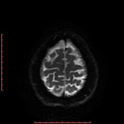 File:Cerebral cavernous malformation (Radiopaedia 26177-26306 Axial DWI 39).jpg