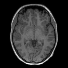Cerebral cavernous venous malformation (Radiopaedia 70008-80021 Axial T1 33).jpg