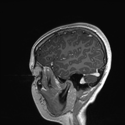 Cerebral cavernous venous malformation (Radiopaedia 70008-80021 Sagittal T1 C+ 59).jpg