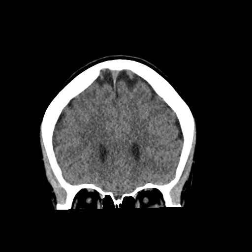 Cerebral cavernous venous malformation (Radiopaedia 70008-80022 non-contrast 20).jpg