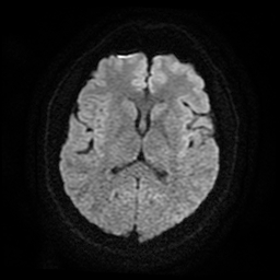 Cerebral cavernous venous malformation (Zabramski type II) (Radiopaedia 85511-101198 Axial DWI 51).jpg