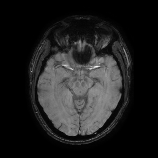 Cerebral cavernous venous malformation (Zabramski type II) (Radiopaedia 85511-101198 Axial SWI 56).jpg