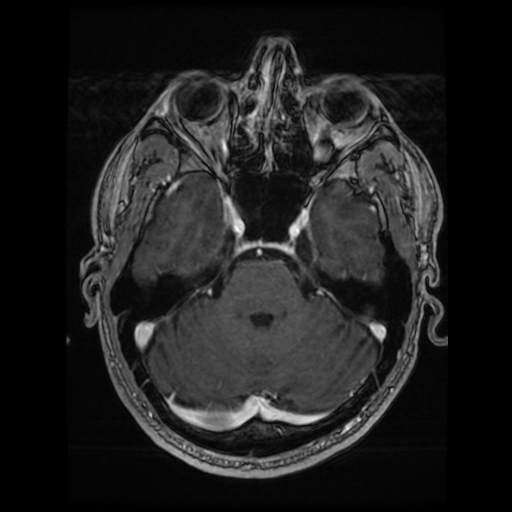 Cerebral cavernous venous malformation (Zabramski type II) (Radiopaedia 85511-101198 Axial T1 C+ fat sat 60).jpg