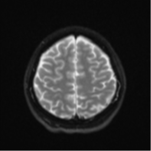 Cerebral cavernous venous malformations (Radiopaedia 48117-52946 Axial DWI 22).png
