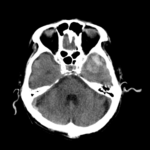 File:Cerebral contusions, subarachnoid hemorrhage and subdural hygromas (Radiopaedia 55399-61827 Axial non-contrast 12).png