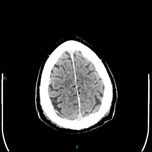 Cerebral contusions (Radiopaedia 33868-35039 Axial non-contrast 190).jpg