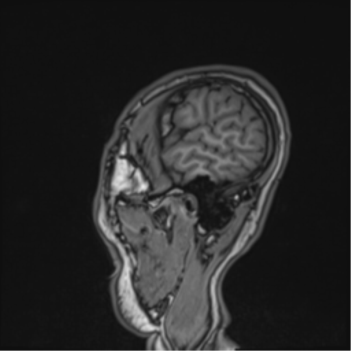 File:Cerebral fat embolism (Radiopaedia 57697-64639 Sagittal T1 12).png