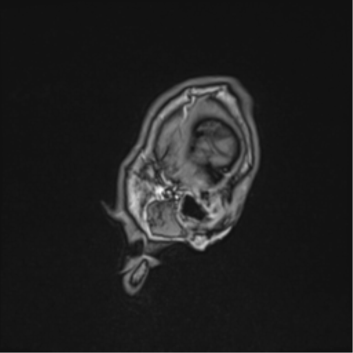 Cerebral fat embolism (Radiopaedia 57697-64639 Sagittal T1 44).png