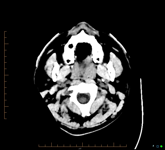 File:Cerebral fat embolism (Radiopaedia 85521-101220 Axial non-contrast 3).jpg