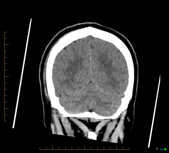 Cerebral fat embolism (Radiopaedia 85521-101220 Coronal non-contrast 49).jpg