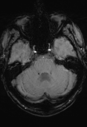File:Cerebral hemorrhagic contusions- temporal evolution (Radiopaedia 40224-42757 D 10).png
