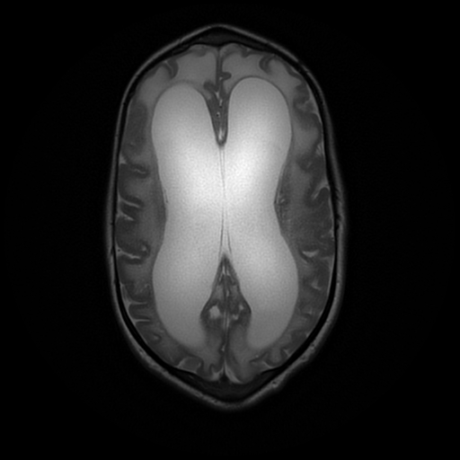 File:Cerebral manifestations of mucopolysaccharidosis type I (Radiopaedia 59171-66487 Axial T2 14).jpg