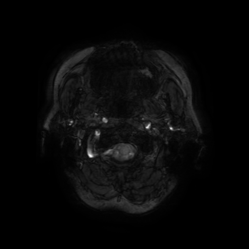 File:Cerebral metastases - melanoma (Radiopaedia 80972-94522 Axial SWI 2).jpg