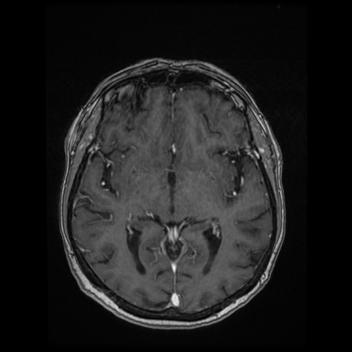 Cerebral metastases - melanoma (Radiopaedia 80972-94522 Axial T1 C+ 52).jpg