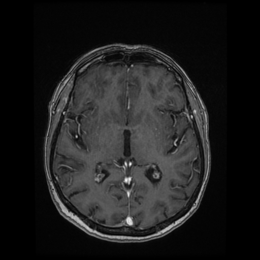 Cerebral metastases - melanoma (Radiopaedia 80972-94522 Axial T1 C+ 54).jpg