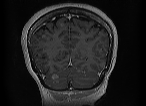 Cerebral metastases from lung cancer with amyloid angiopathy and cerebellopontine angle meningioma (Radiopaedia 74306-85191 Coronal T1 C+ 48).jpg