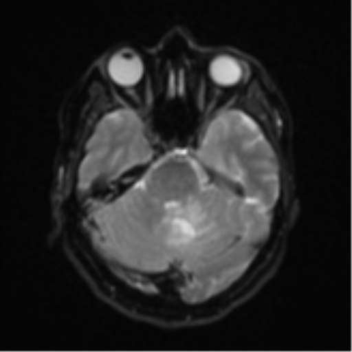 Cerebral metastases mimicking abscesses (Radiopaedia 45841-50131 Axial DWI 10).png