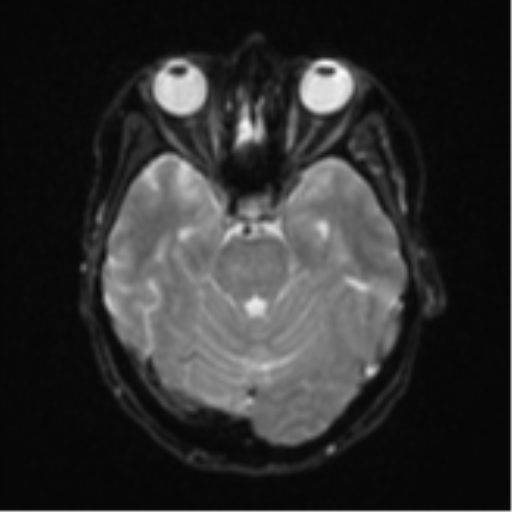 File:Cerebral metastasis (Radiopaedia 46744-51248 Axial DWI 9).png