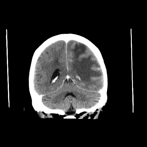 File:Cerebral metastasis (Radiopaedia 46744-51260 Axial C+ delayed 1).png