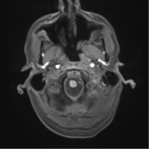 File:Cerebral metastasis - melanoma (Radiopaedia 54718-60954 Axial T1 6).png