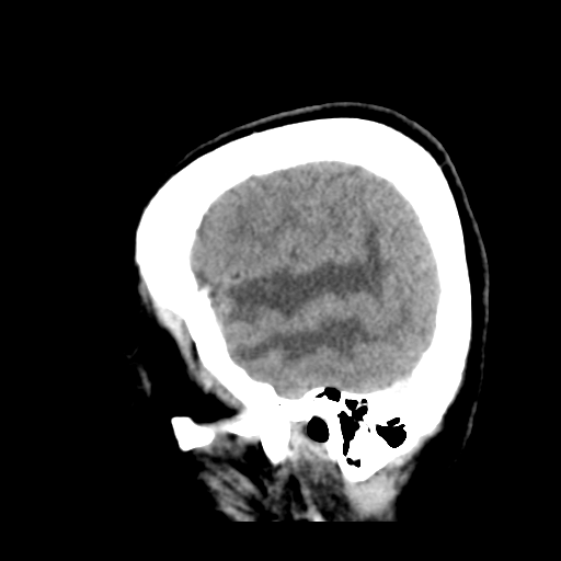 File:Cerebral metastasis to basal ganglia (Radiopaedia 81568-95412 Sagittal C+ delayed 11).png