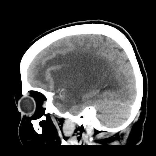 Cerebral metastasis to basal ganglia (Radiopaedia 81568-95412 Sagittal C+ delayed 18).png