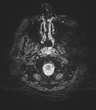 Cerebral metastasis to basal ganglia (Radiopaedia 81568-95413 Axial SWI 3).png