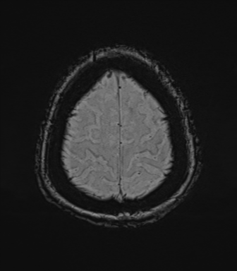Cerebral metastasis to basal ganglia (Radiopaedia 81568-95413 Axial SWI 77).png