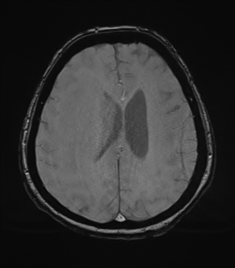 Cerebral metastasis to basal ganglia (Radiopaedia 81568-95413 Axial SWI magnitude 59).png