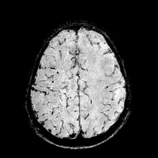 Cerebral parenchymal arteriovenous malformation (Radiopaedia 27280-27456 Axial SWI 88).jpg