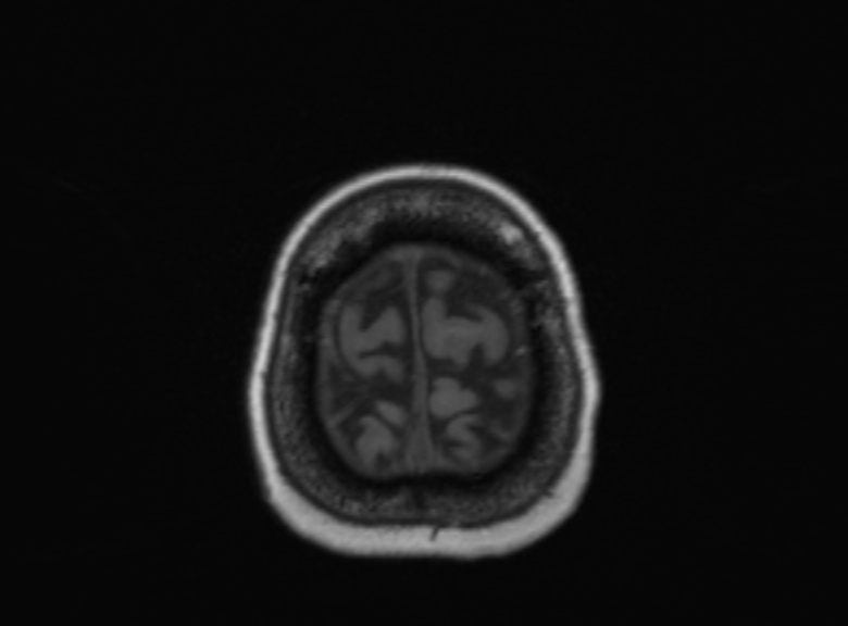 Cerebral ring enhancing lesions - cerebral metastases (Radiopaedia 44922-48817 Axial T1 113).jpg