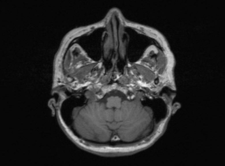 Cerebral ring enhancing lesions - cerebral metastases (Radiopaedia 44922-48817 Axial T1 326).jpg