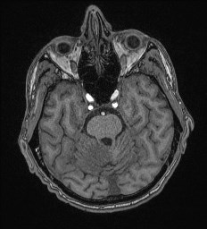 Cerebral toxoplasmosis (Radiopaedia 43956-47461 Axial T1 23).jpg