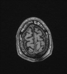 Cerebral toxoplasmosis (Radiopaedia 43956-47461 Axial T1 72).jpg