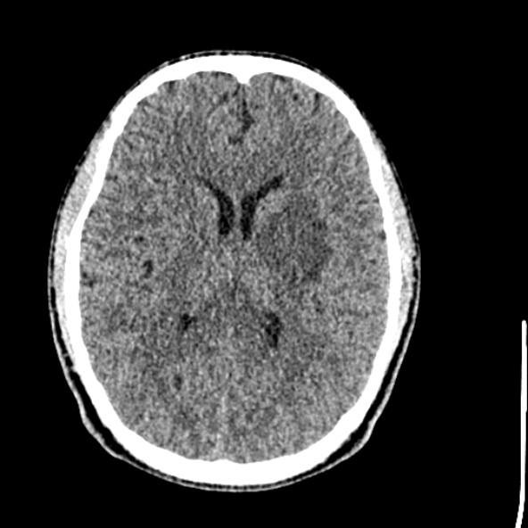 Cerebral toxoplasmosis (Radiopaedia 53993-60131 Axial non-contrast 46).jpg