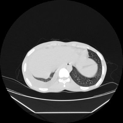 Cerebral tuberculoma (Radiopaedia 80829-94318 Axial lung window 161).jpg