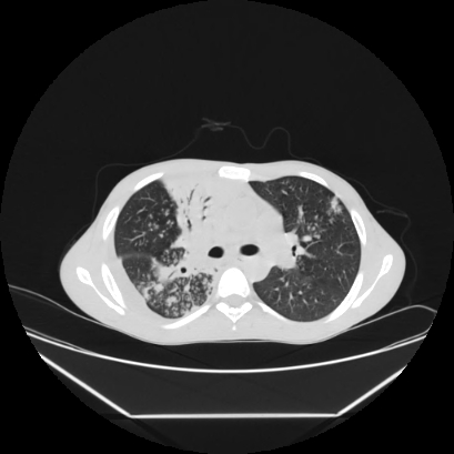 File:Cerebral tuberculoma (Radiopaedia 80829-94318 Axial lung window 68).jpg