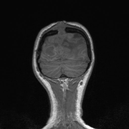 Cerebral tuberculosis with dural sinus invasion (Radiopaedia 60353-68090 Coronal T1 158).jpg