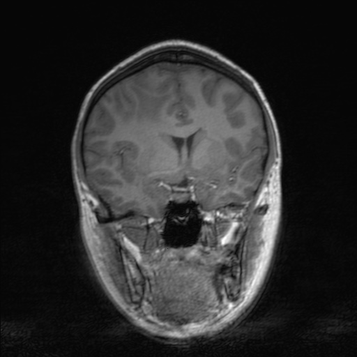 Cerebral tuberculosis with dural sinus invasion (Radiopaedia 60353-68090 Coronal T1 81).jpg