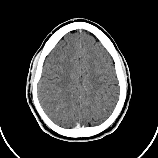 File:Cerebral venous angioma (Radiopaedia 69959-79977 B 77).jpg