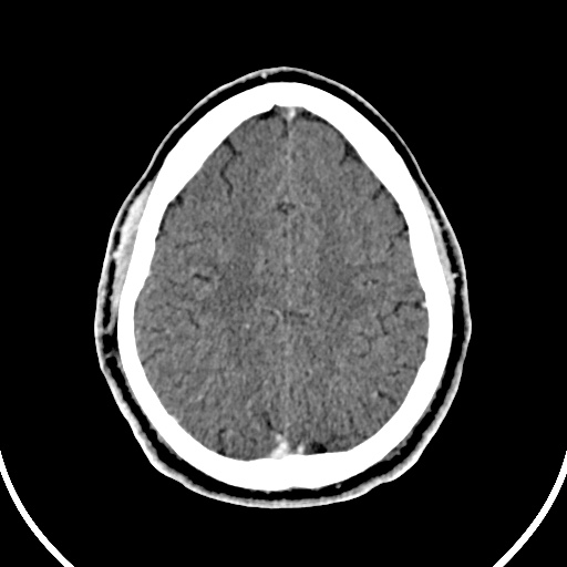 File:Cerebral venous angioma (Radiopaedia 69959-79977 B 79).jpg