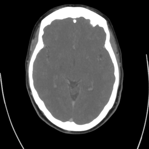 Cerebral venous infarct related to dural venous sinus thromboses (Radiopaedia 35292-36804 Axial C+ delayed 23).png