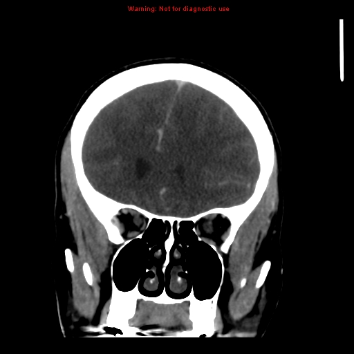 Cerebral venous infarction (Radiopaedia 12404-20735 B 23).jpg