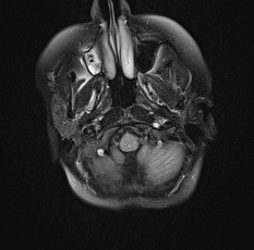 File:Cerebral venous infarction - hemorrhagic (Radiopaedia 81625-95505 Axial FLAIR 4).jpg